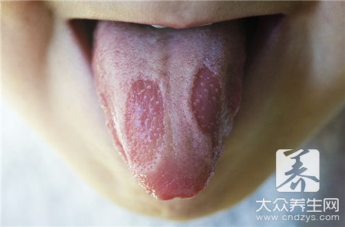 没有舌苔是怎么回事呢？ 