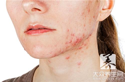 如何用蜂蜜涂痘痘呢？怎么治疗呢？