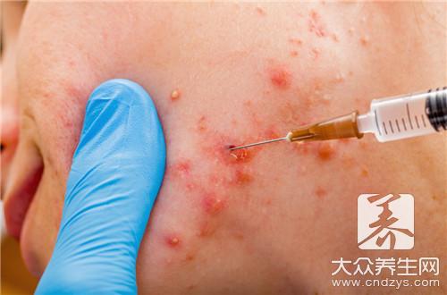 如何用蜂蜜涂痘痘呢？怎么治疗呢？