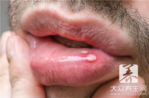 出现口疮不能吃什么？(1)