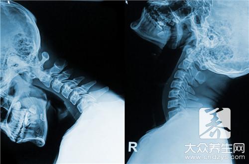 颈椎病如何治疗有效？