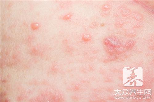 过敏起不痒的红疙瘩，如何食疗
