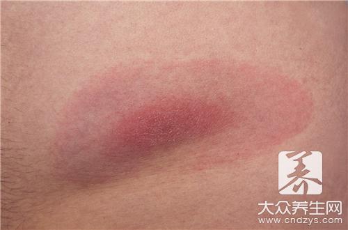 结节性红斑饮食应注意什么 结节性红斑饮食应注意什么