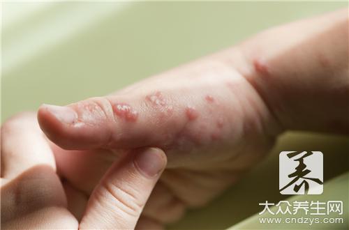 皮肌炎的死亡率到底高不高