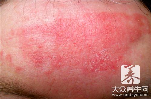 大人发烧后出疹子的原因