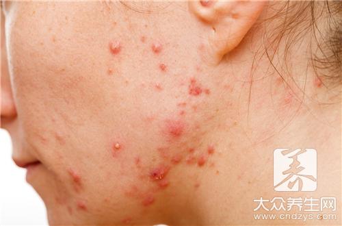 小儿丘疹性荨麻疹