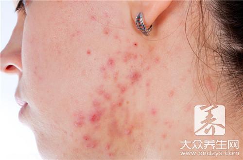 脸上长青春痘怎么办