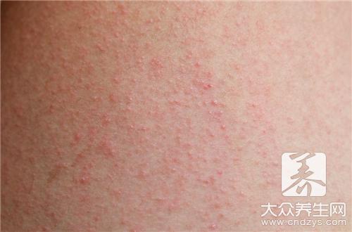 小儿湿疹的治疗方法