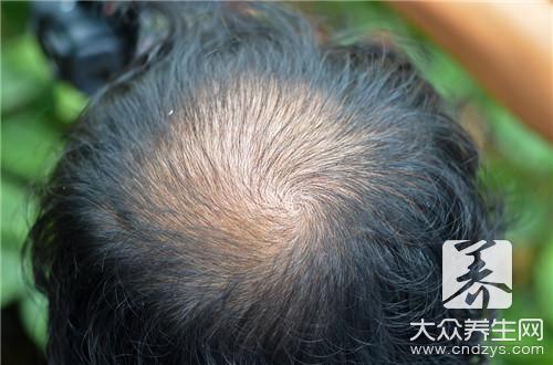 斑秃的病因有哪些?是缺什么?