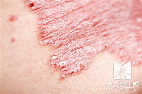 用醋熬花椒真的能治癣吗？