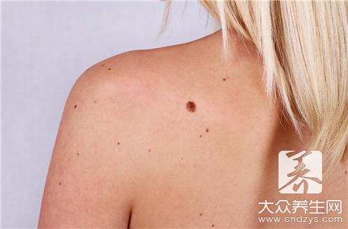 胎记怎么去除比较健康方便