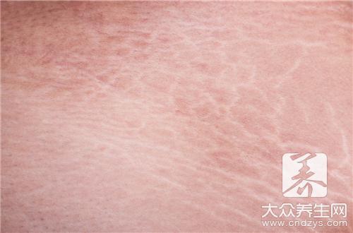 鱼鳞病偏方  