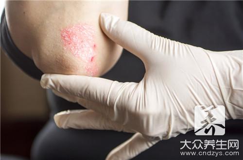 银屑病怎么治