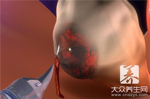 什么是巧克力囊肿