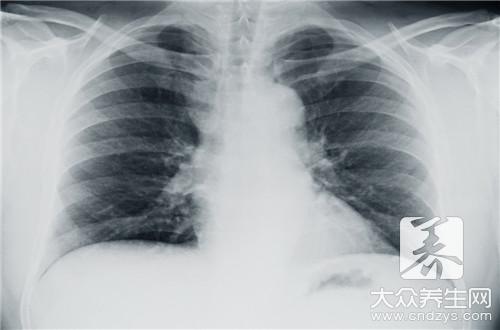 中医治疗结核性胸膜炎的妙方有哪些？