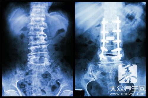 先天性脊柱侧弯手术要注意什么？