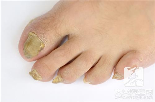 灰指甲如何根除呢？