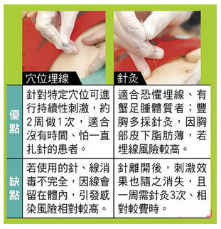 减肥 中医减肥方法 埋线减肥法