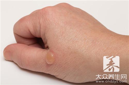 鹅掌风症状是怎样的?